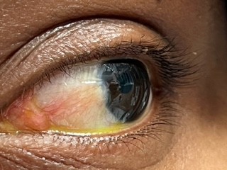 Pterygium